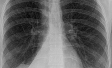 Atelektaza pluća