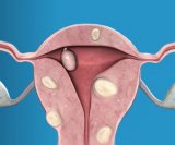fibroidi-miom-maternice