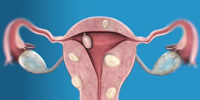 fibroidi-miom-maternice