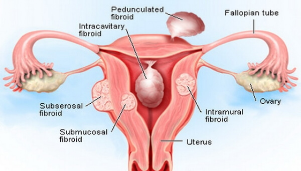 miom fibroid
