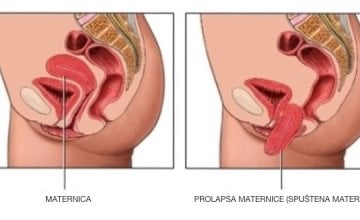 prolapsa-maternice-spustena-maternica