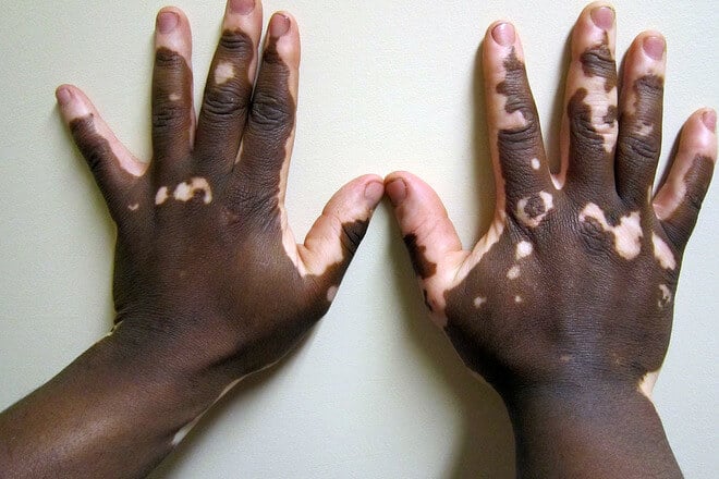 vitiligo 