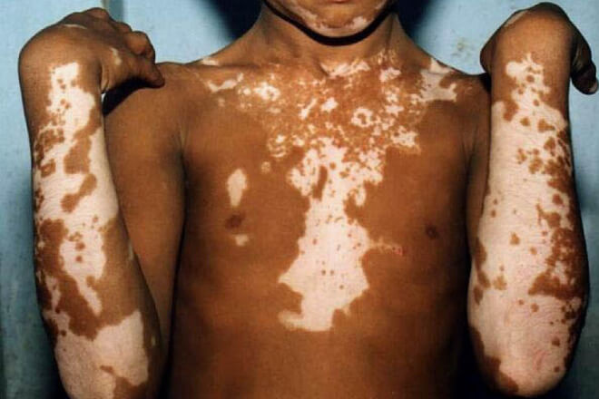 vitiligo kod djece
