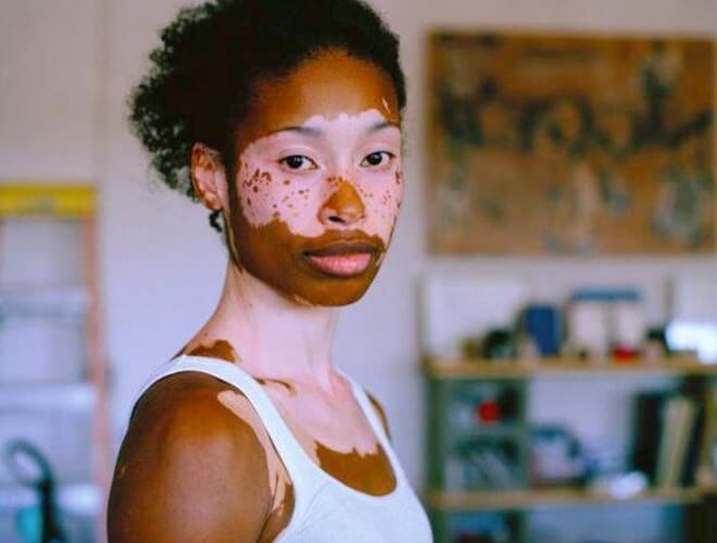 vitiligo na licu