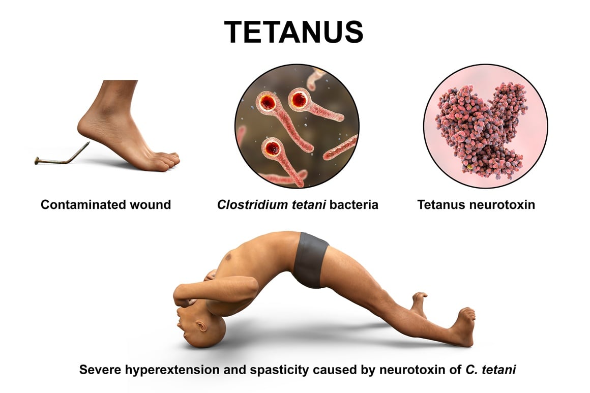 Tetanus - simptomi