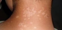 tinea versicolor