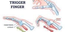 trigger finger - simptomi