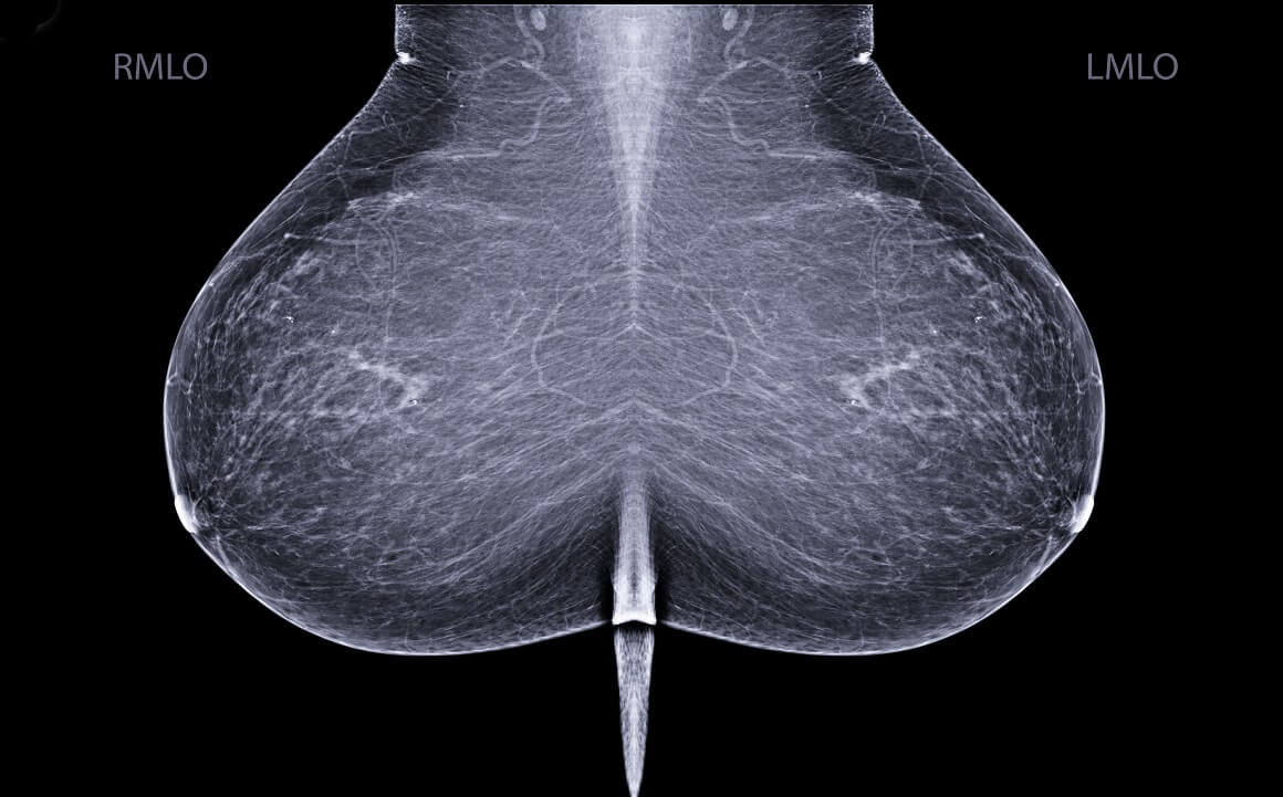 Mamografija - nalaz