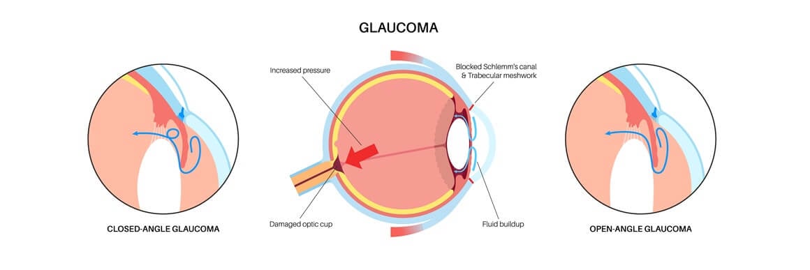Očni tlak - vrijednosti