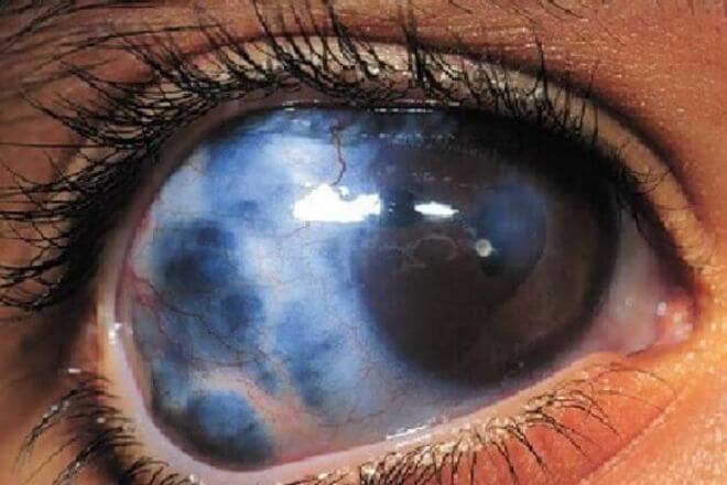 Glaukom ili očni tlak