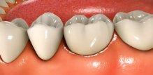 Stupnjevi periodontitisa