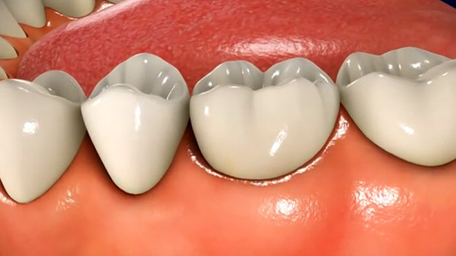 Stupnjevi periodontitisa