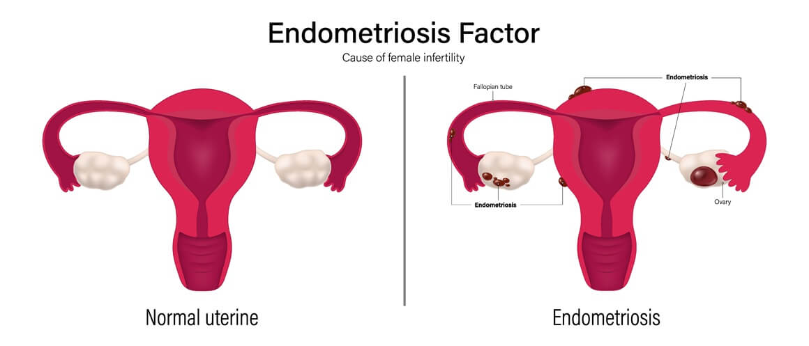 Endometrioza jajnika