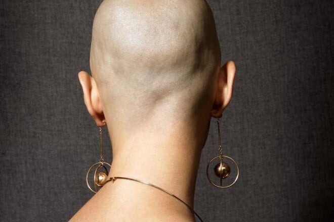 alopecia