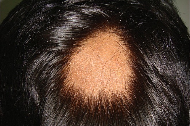 alopecia areata