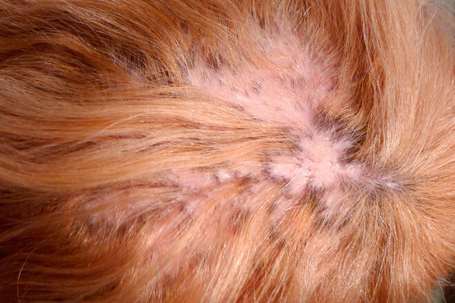 cikatricijalna alopecija