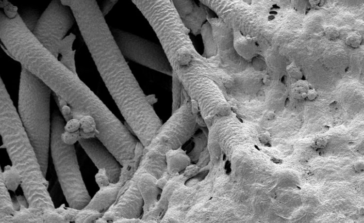 Rak grla – uzroci, simptomi, faktori rizika i liječenje | Kreni zdravo!