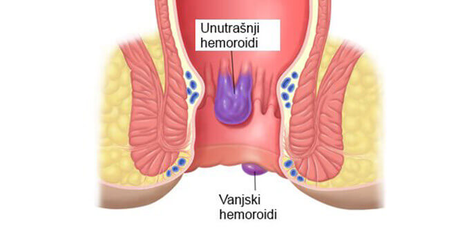 unutarnji-vanjski-hemoroidi