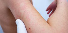 Parvovirus ili peta bolest - simptomi