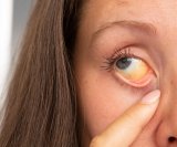 žutica kod odraslih