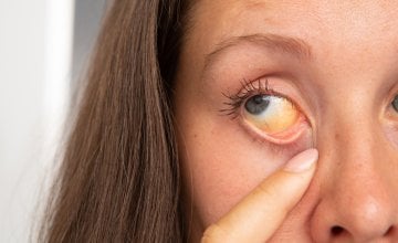 žutica kod odraslih