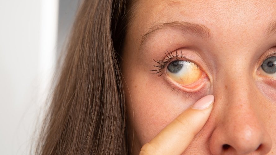 žutica kod odraslih