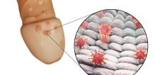 genitalni herpes - muškarci