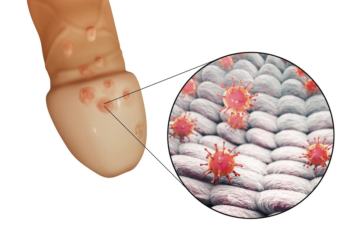 genitalni herpes - muškarci