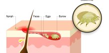 Scabies - uzročnik