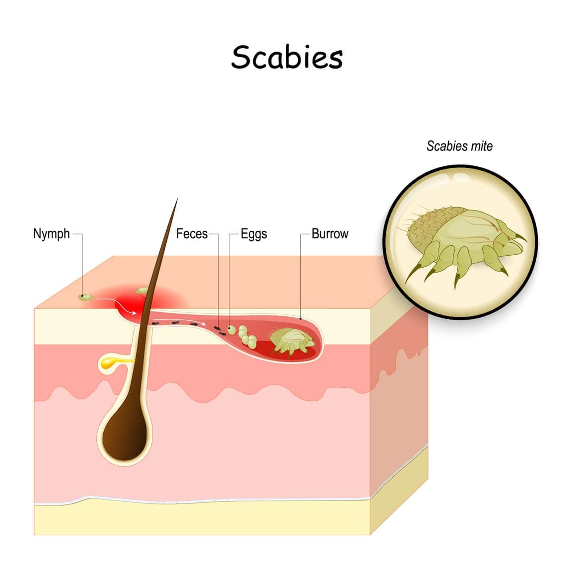 Scabies - uzročnik