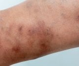 Svrab (šuga ili scabies)