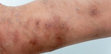 Svrab (šuga ili scabies)