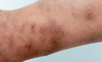 Svrab (šuga ili scabies)