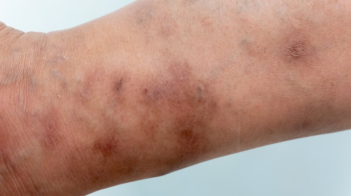 Svrab (šuga ili scabies)