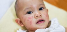 Alergija na sunce kod djece