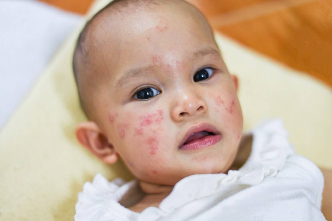 Alergija na sunce kod djece