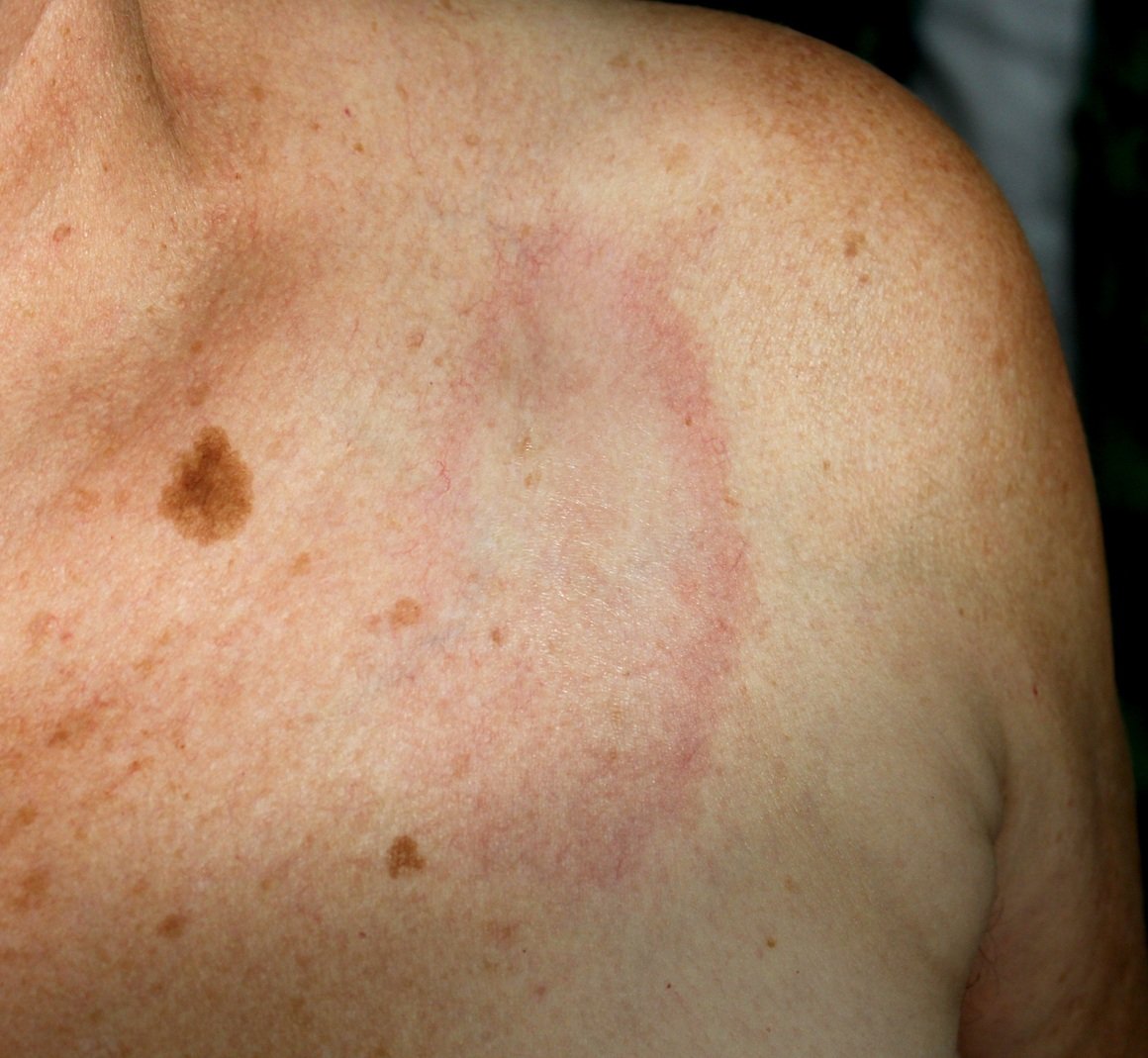 Lokalizirana sklerodermija