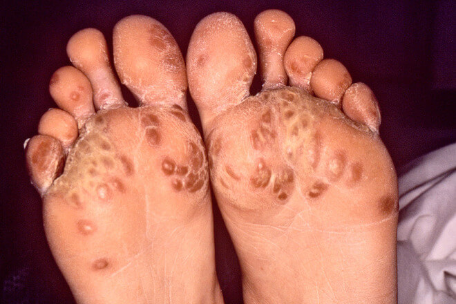 artritis stopala liječenje artritisa