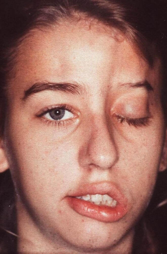 Sklerodermija lica