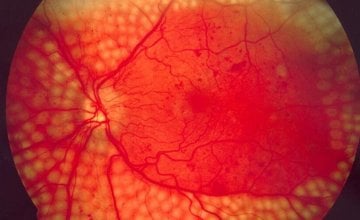dijabeticka retinopatija