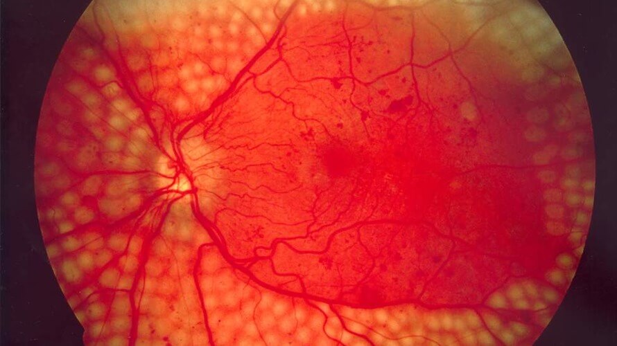 dijabeticka retinopatija