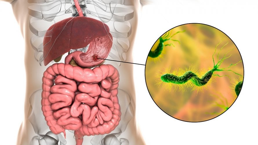 Helicobacter pylori