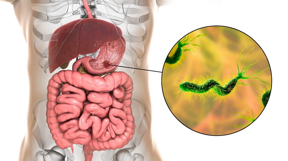 Helicobacter pylori