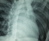 Pneumotoraks Uzroci, simptomi i koliko je opasan