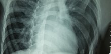 Pneumotoraks Uzroci, simptomi i koliko je opasan