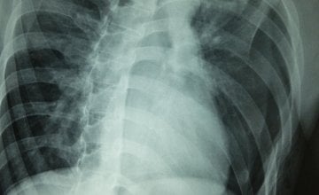 Pneumotoraks Uzroci, simptomi i koliko je opasan