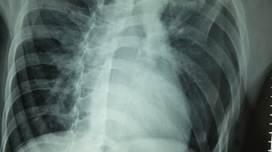 Pneumotoraks Uzroci, simptomi i koliko je opasan