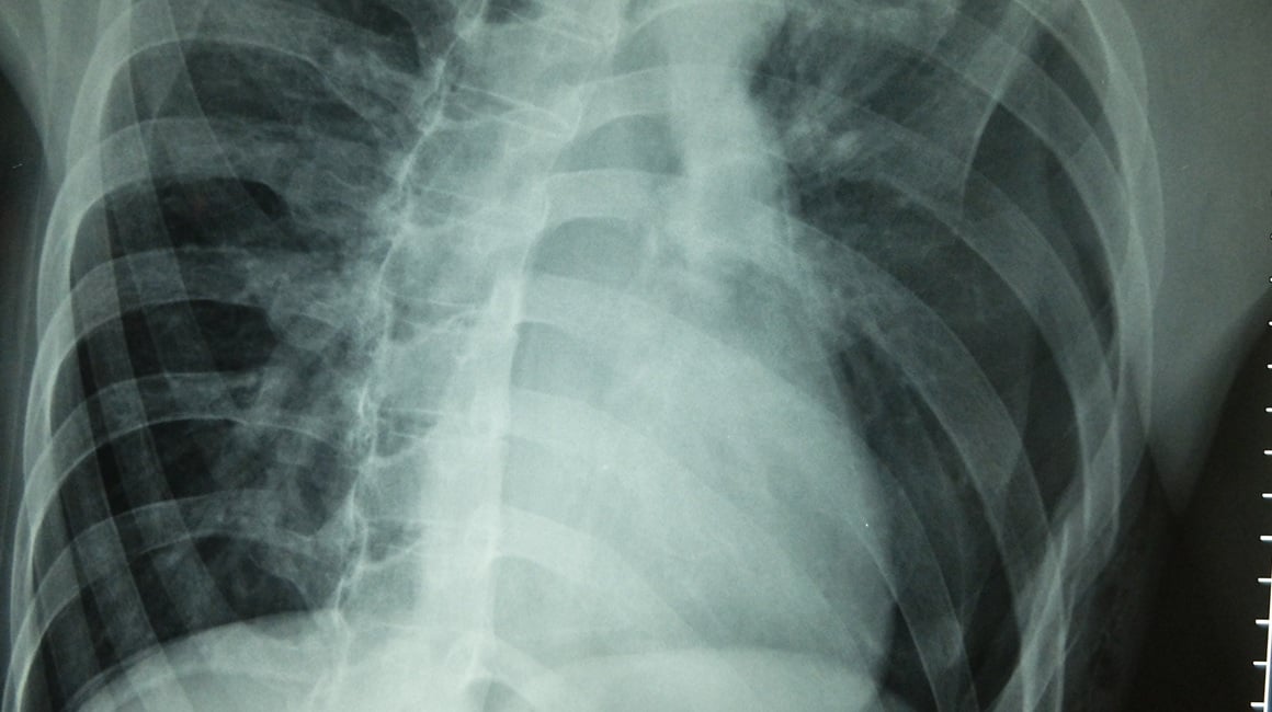 Pneumotoraks Uzroci, simptomi i koliko je opasan