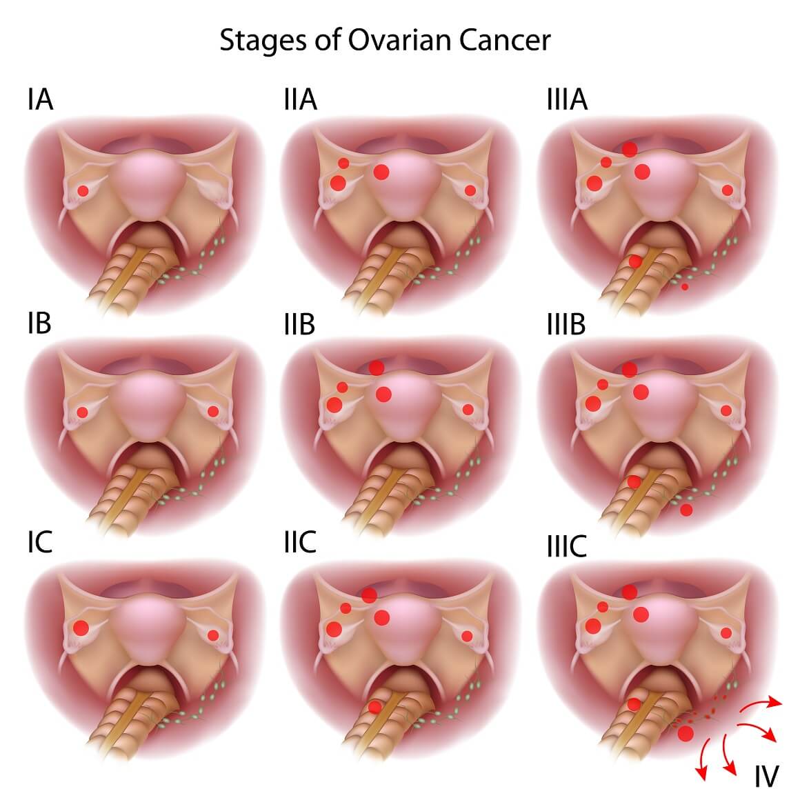 Rak jajnika - stadiji i vrste