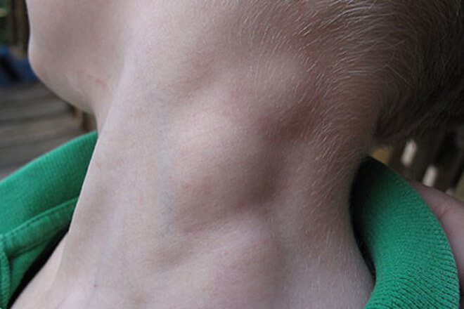 bol u limfnim čvorovima i zglobovima tinejdžer ima bolove u zglobu kuka